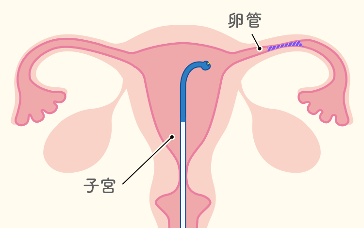 卵管通気検査、卵管通水検査