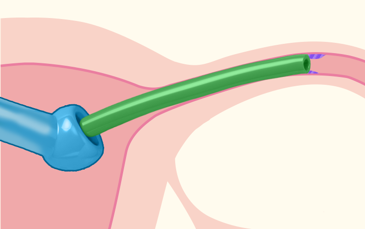 卵管通気検査、卵管通水検査
