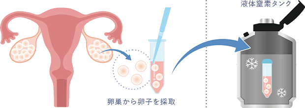 卵子凍結とは